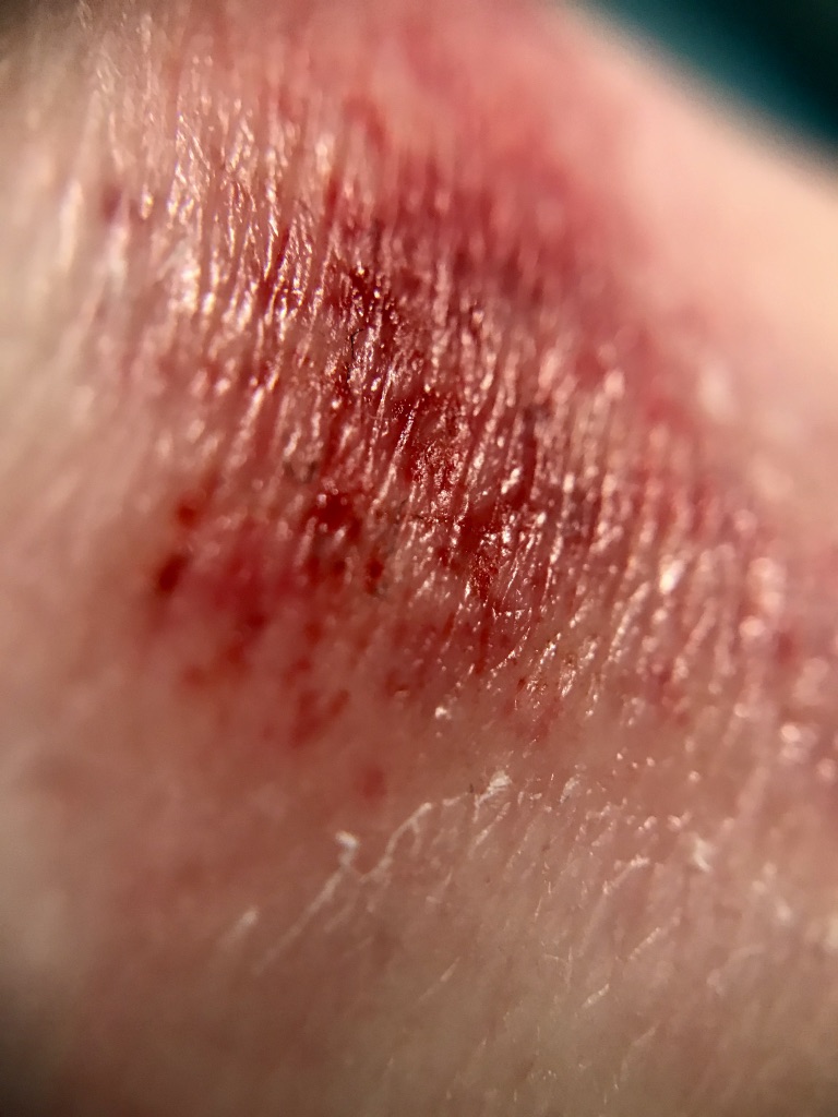 Close up of a scraped bloody knee.